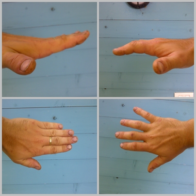  Ľavá ruka – relatívne OK. Pravá ruka v maximálnej miere spojenia prstov a ohnutia dlane (viac to nešlo)